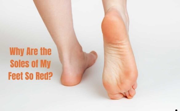 Why Are the Soles of My Feet So Red?